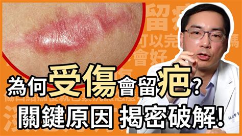 人中受傷|好醜！受傷為何會留疤？醫曝「4大影響因子」：這2部位最難消失。